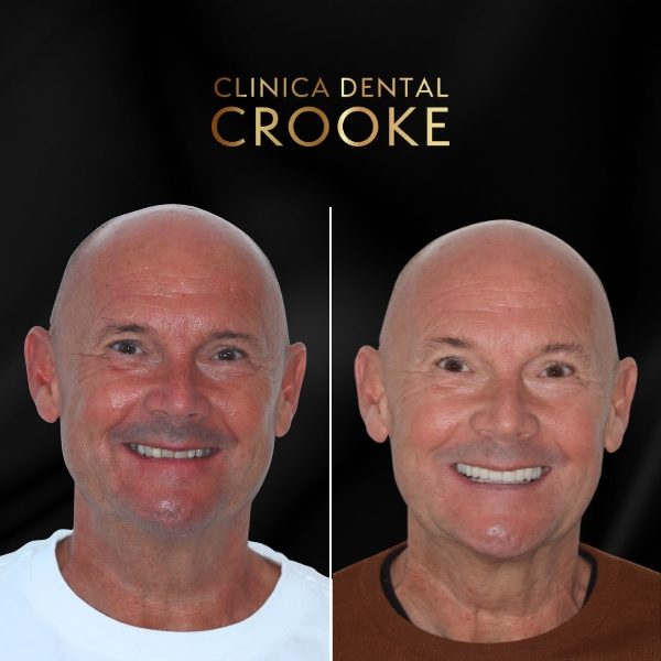 Antes y después del tratamiento, a la izquierda antes y a la derecha después: coronas sobre dientes del sector anterior